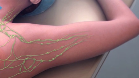 swollen lymph nodes in armpit swollen lymph nodes in armpit
