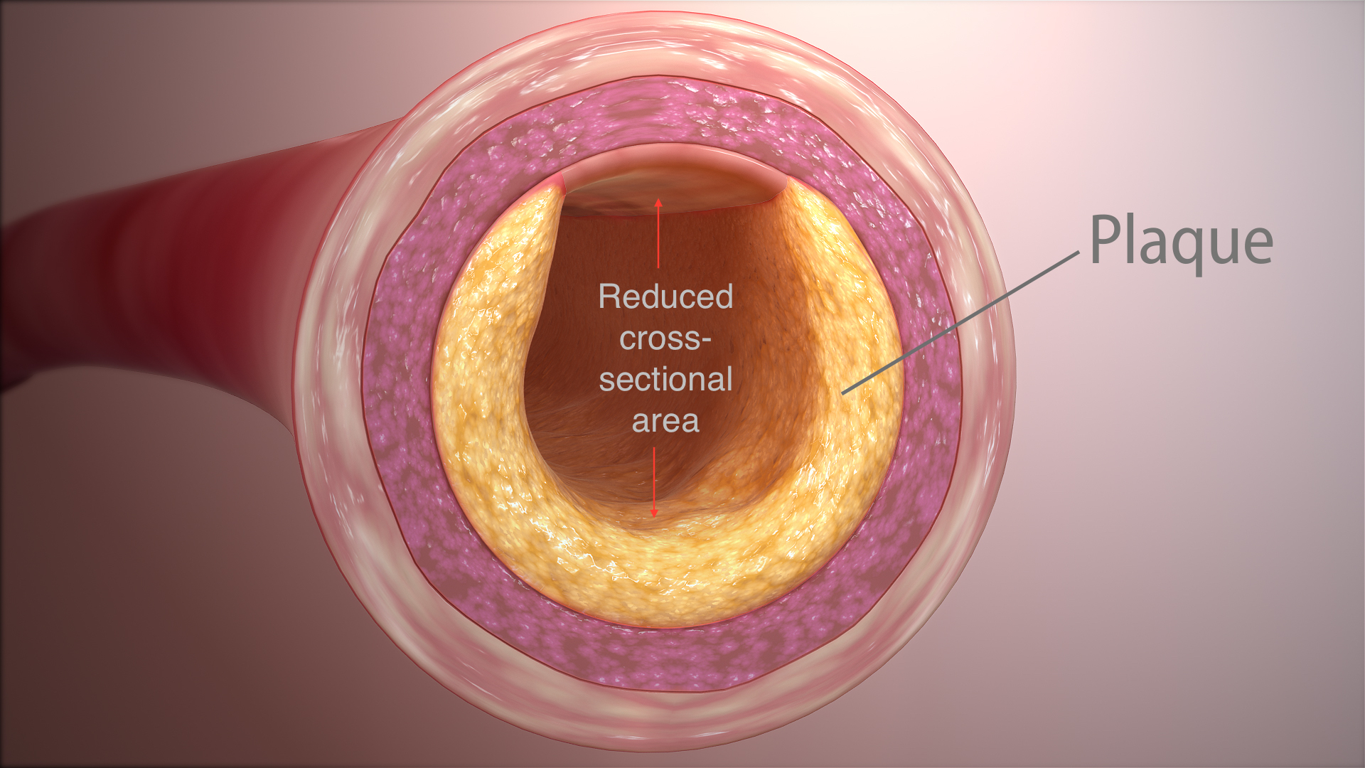 how-clearing-heart-s-clogged-arteries-similar-to-restoring-a-monument