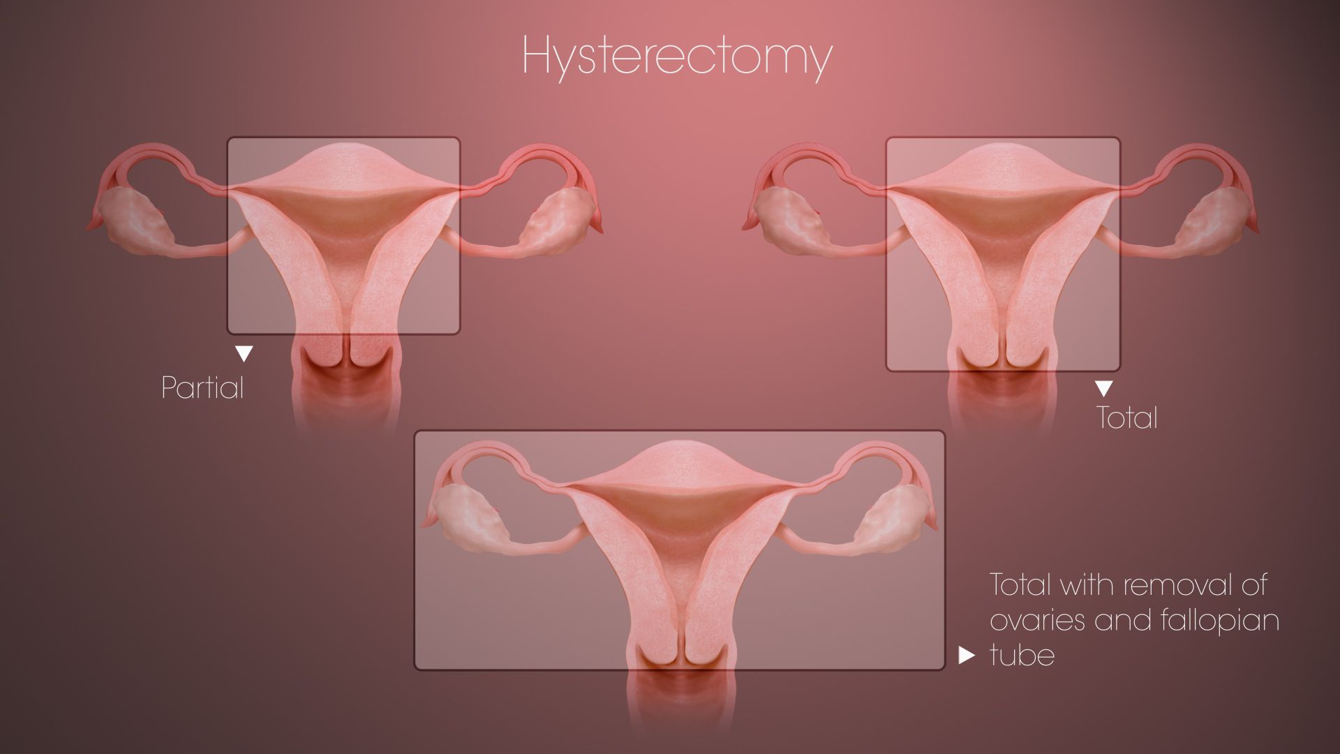 partial hysterectomy
