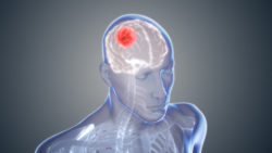 Glioblastoma: The Cancer of Brain