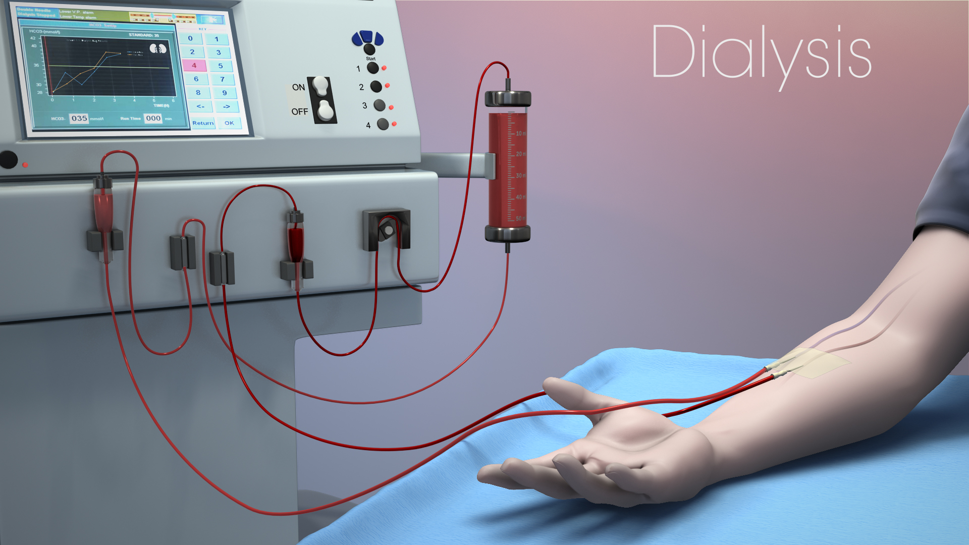 A Key Advancement In Hemodialysis Scientific Animations