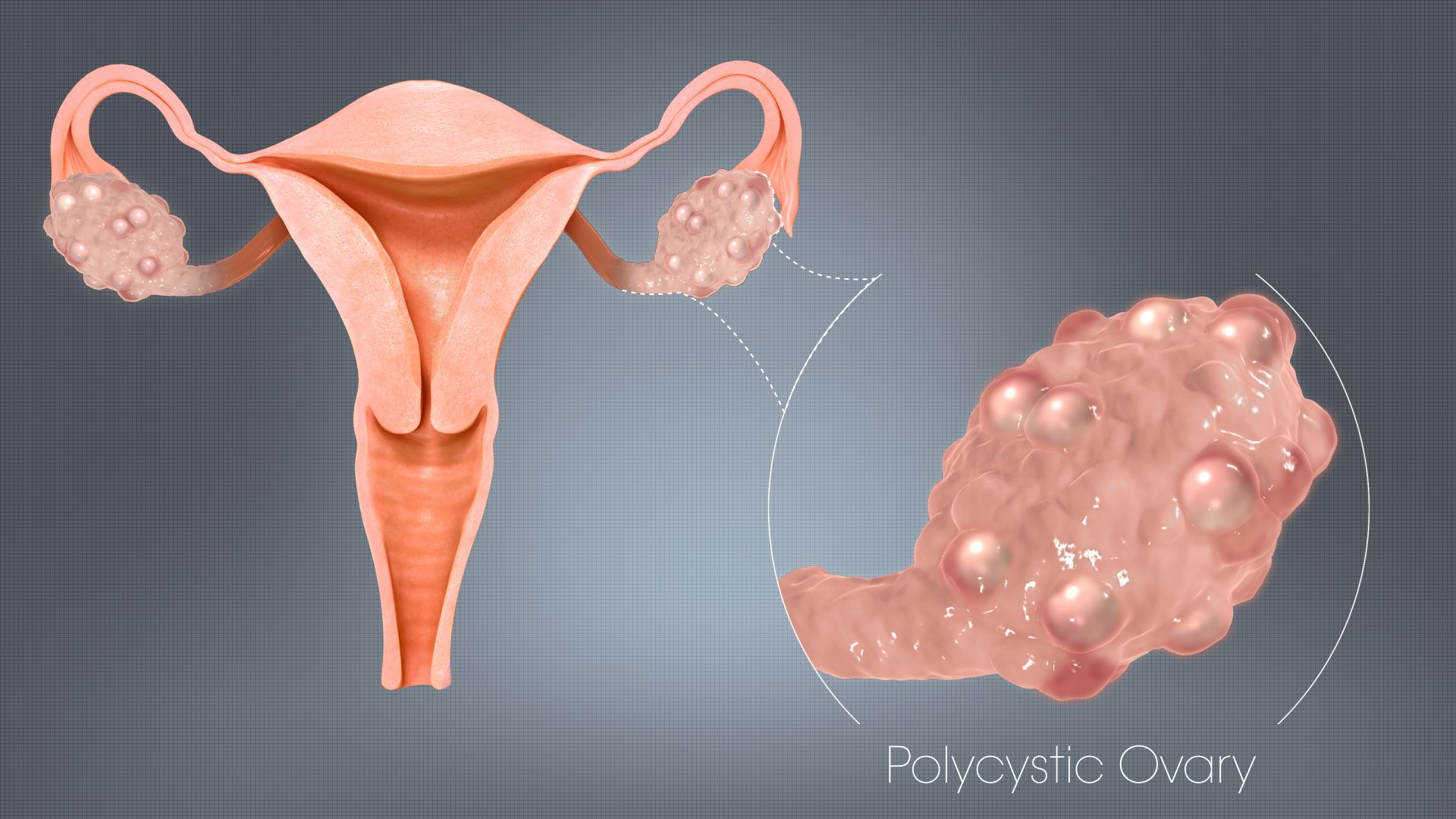 PCOS: A Mysterious Disorder - Scientific Animations