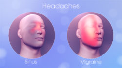 sinus migraine