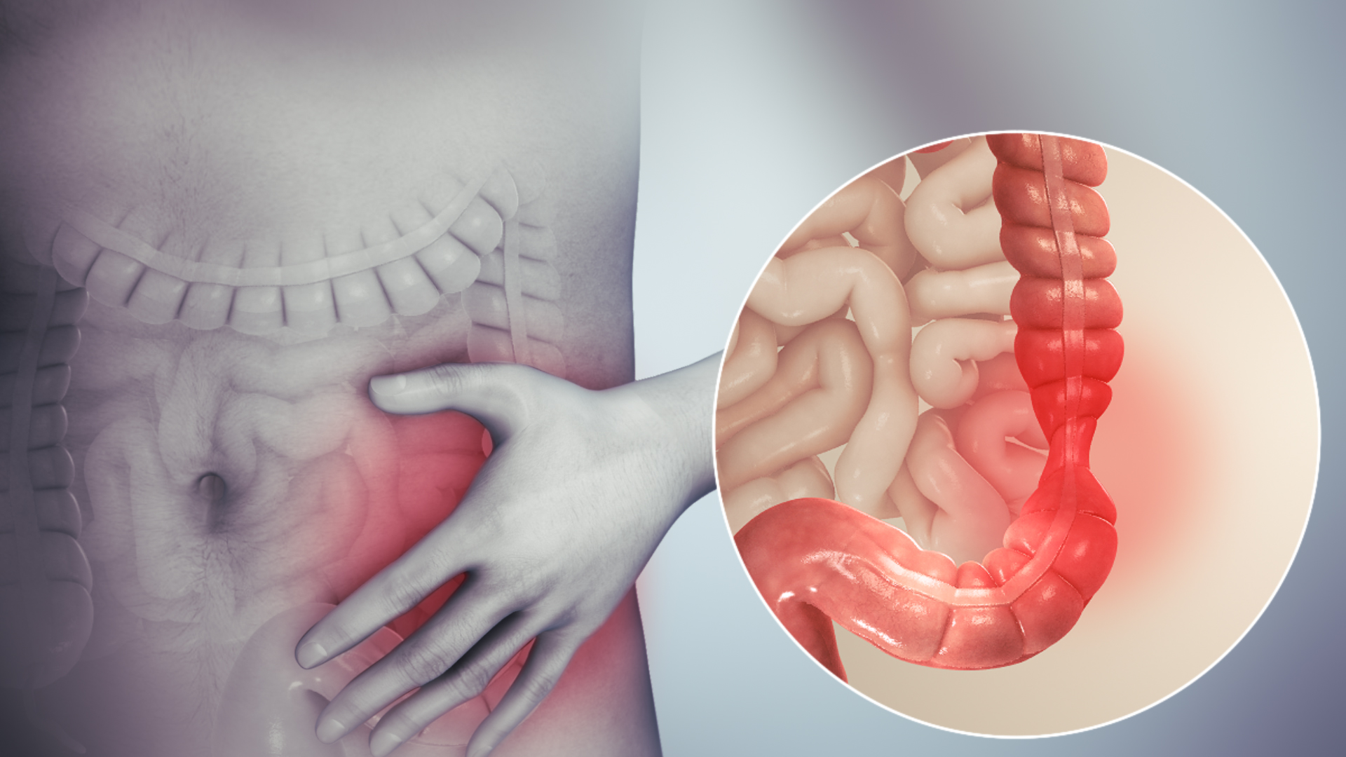 what is irritable bowel disease