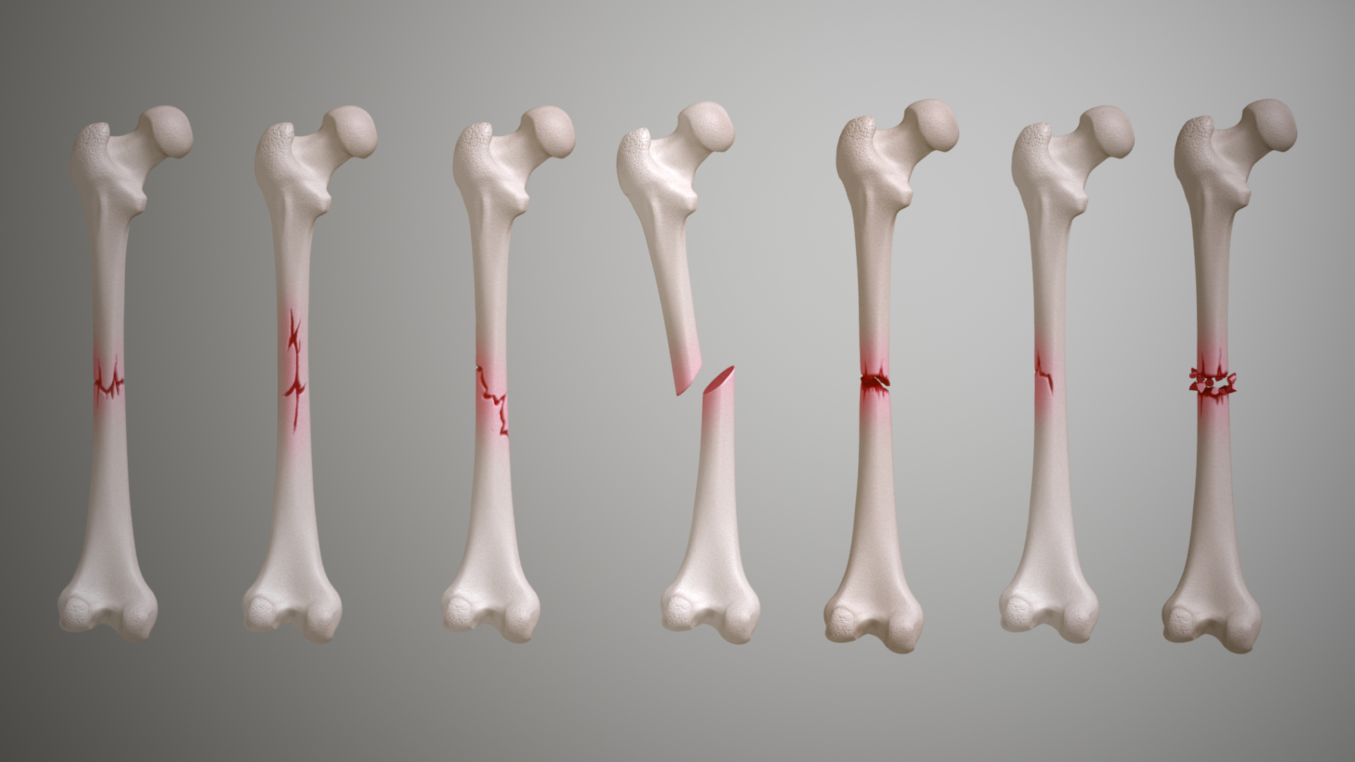 comminuted fracture causes