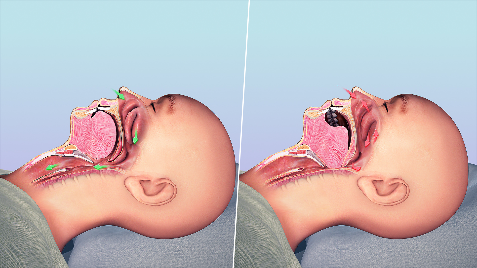 Sleep Apnea: Causes, Symptoms, and Treatment - Scientific Animations