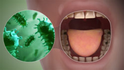3D medical animation still showing Bad Breath