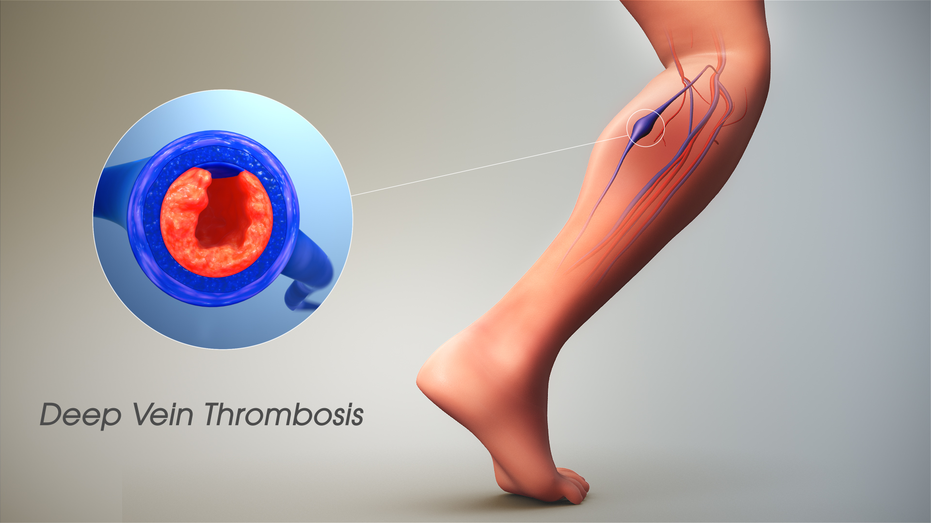 3D medical animation still showing Deep Vein Thrombosis