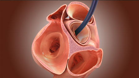 Aortic Valve