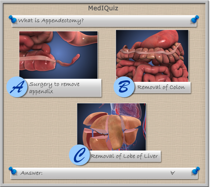 What is appendectomy?