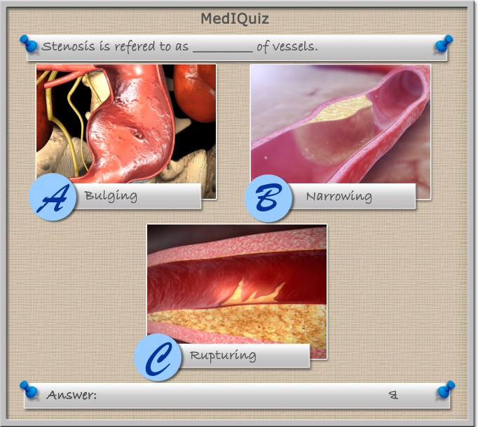 What does Stenosis of blood vessels mean?