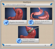 MedIQuiz - What is sleeve gastrectomy?
