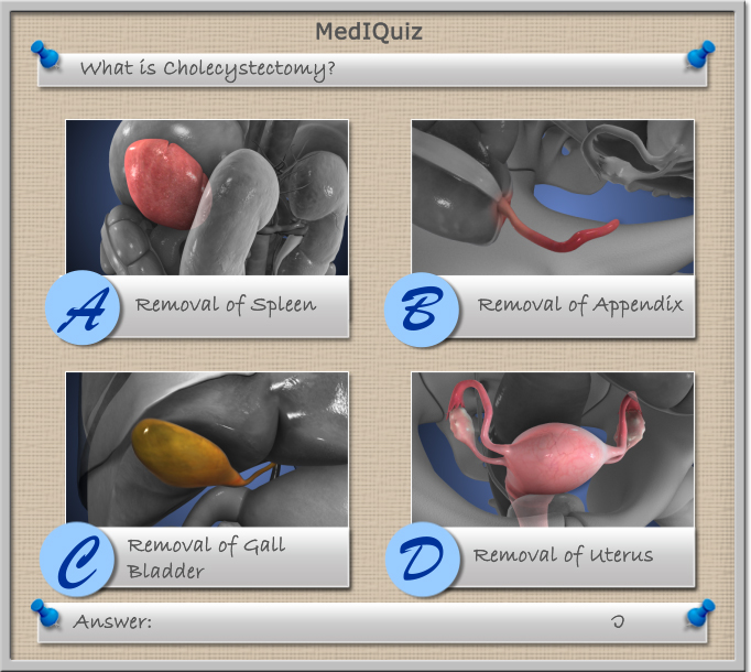 MedIQuiz - What is cholecystectomy?