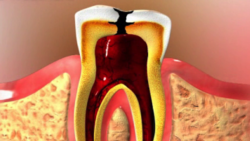 What treatment is done for inflamed, infected, or dead pulp of the tooth?
