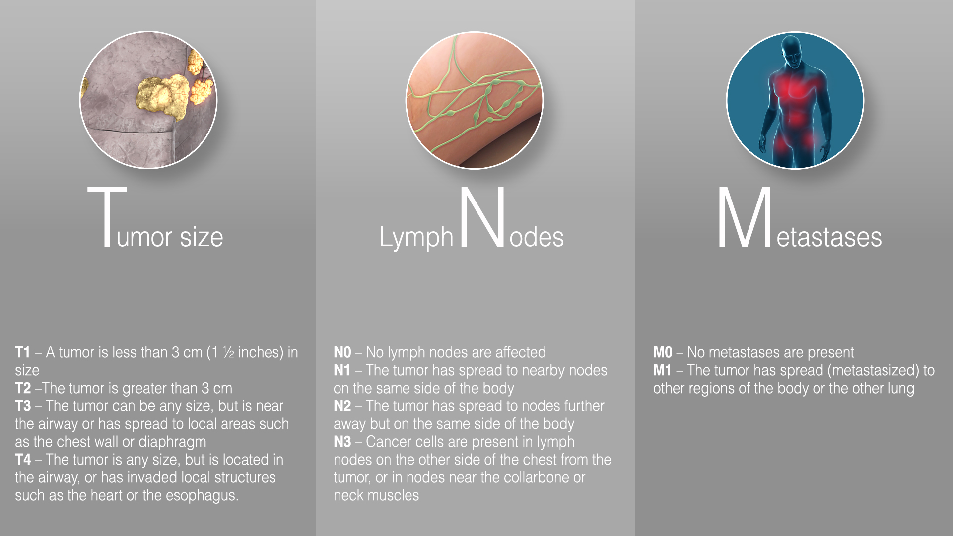 Lungs cancer - TNM:Tumor size, Lymph nodes, Metastases