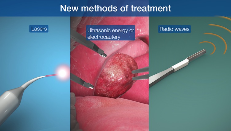 New methods for treatment of tonsils - lasers, ultrasonic energy, radio waves