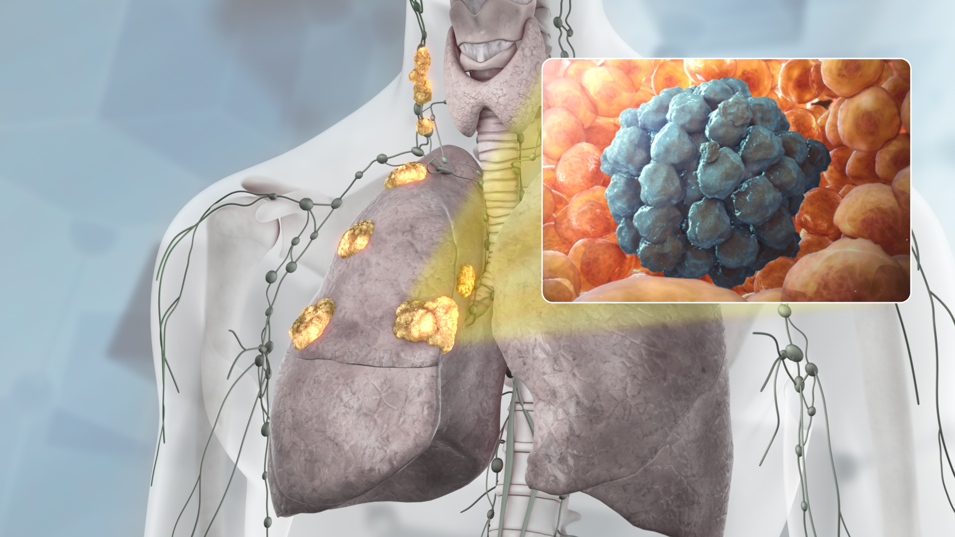 Lungs affected by lung cancer