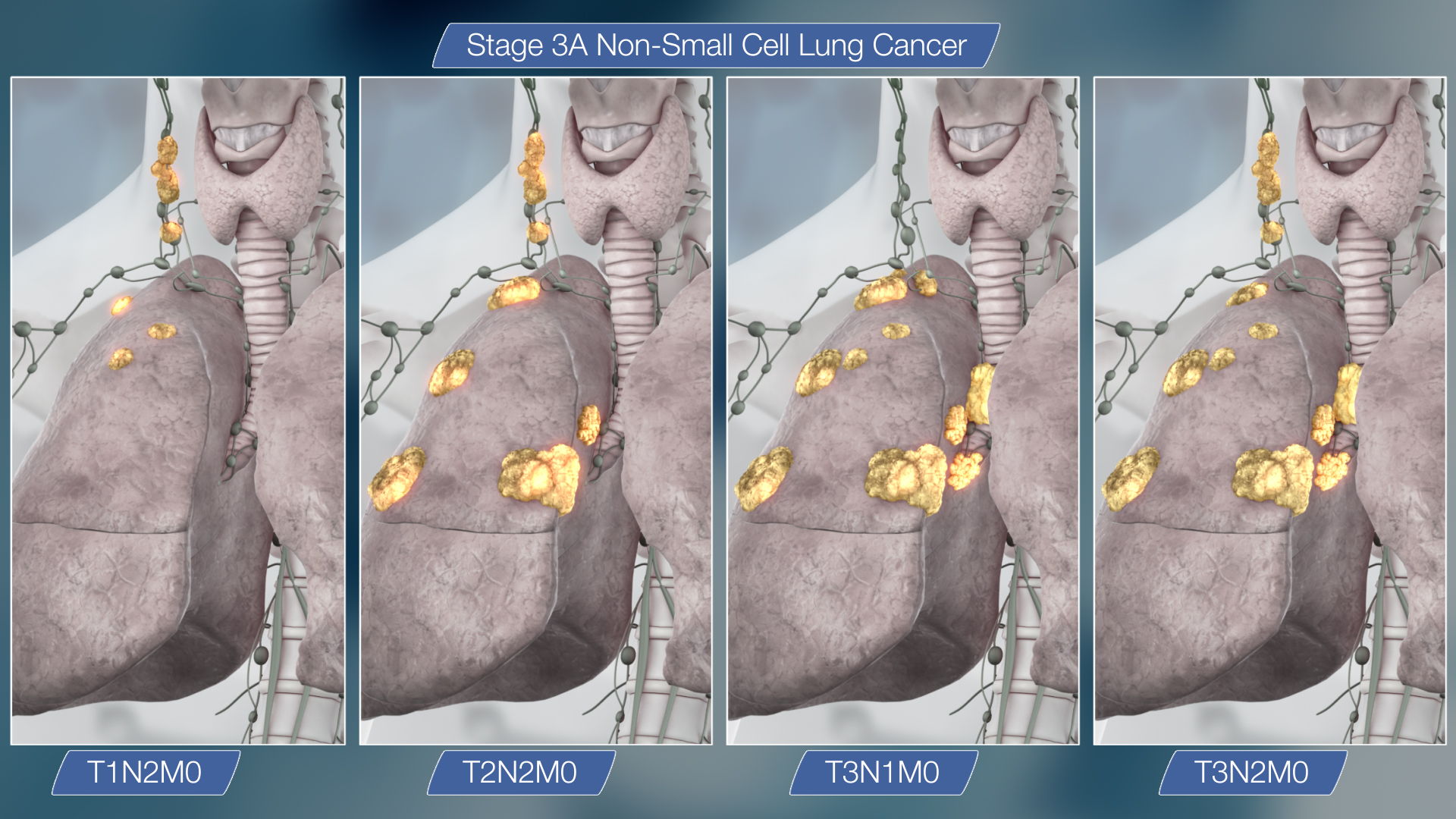 Lungs cancer - Stage 3A