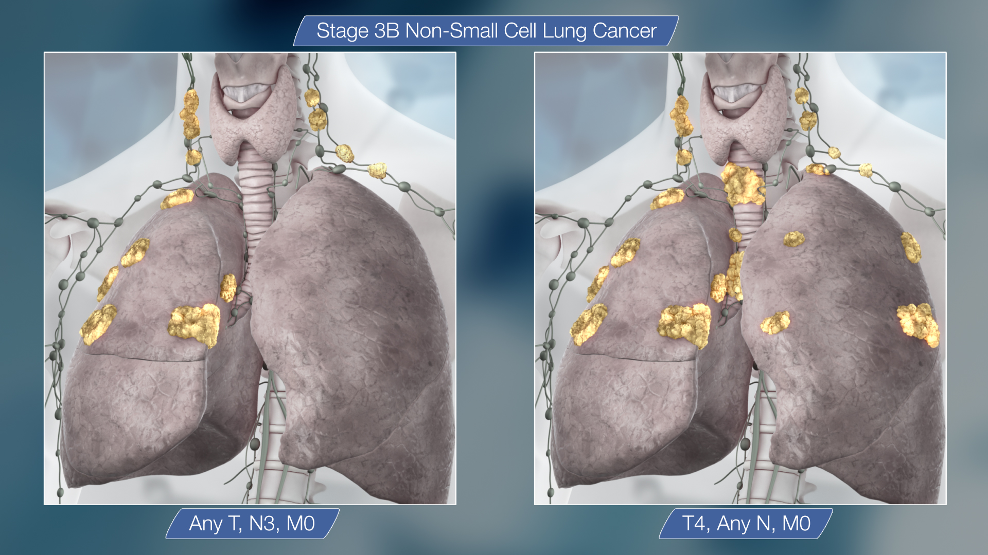 Lungs cancer - Stage 3B