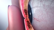 Dysfunction of glands in the eye