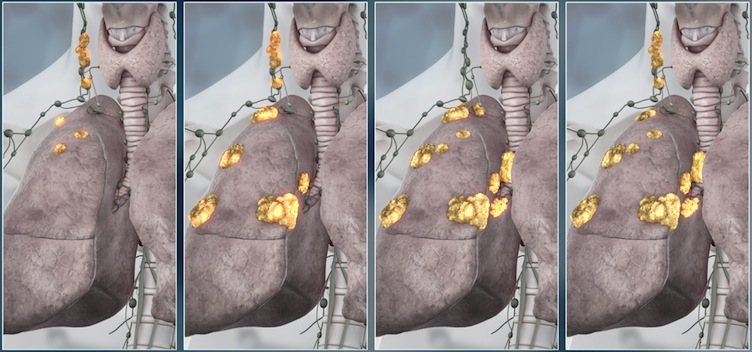 Cancer spread through lymph nodes