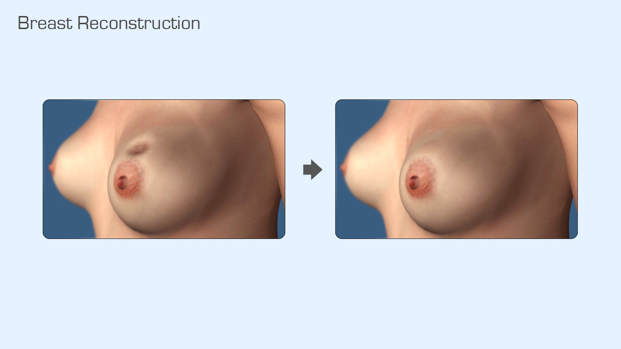 3D Medical Illustration - Breast Reconstruction Surgery