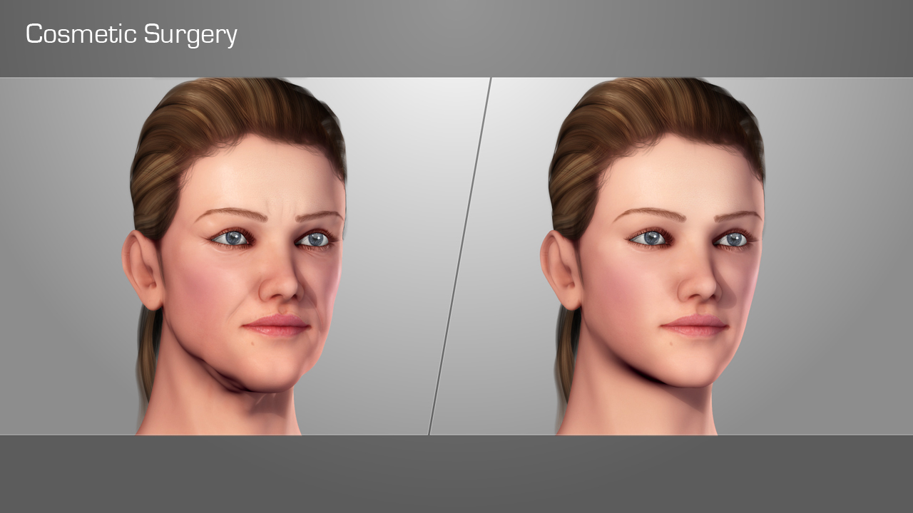 3D Medical Illustration - Cosmetic Surgery