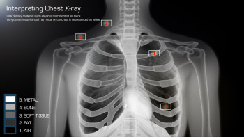 3D Medical Illustration - Interpreting a Chest X-ray - IOW44