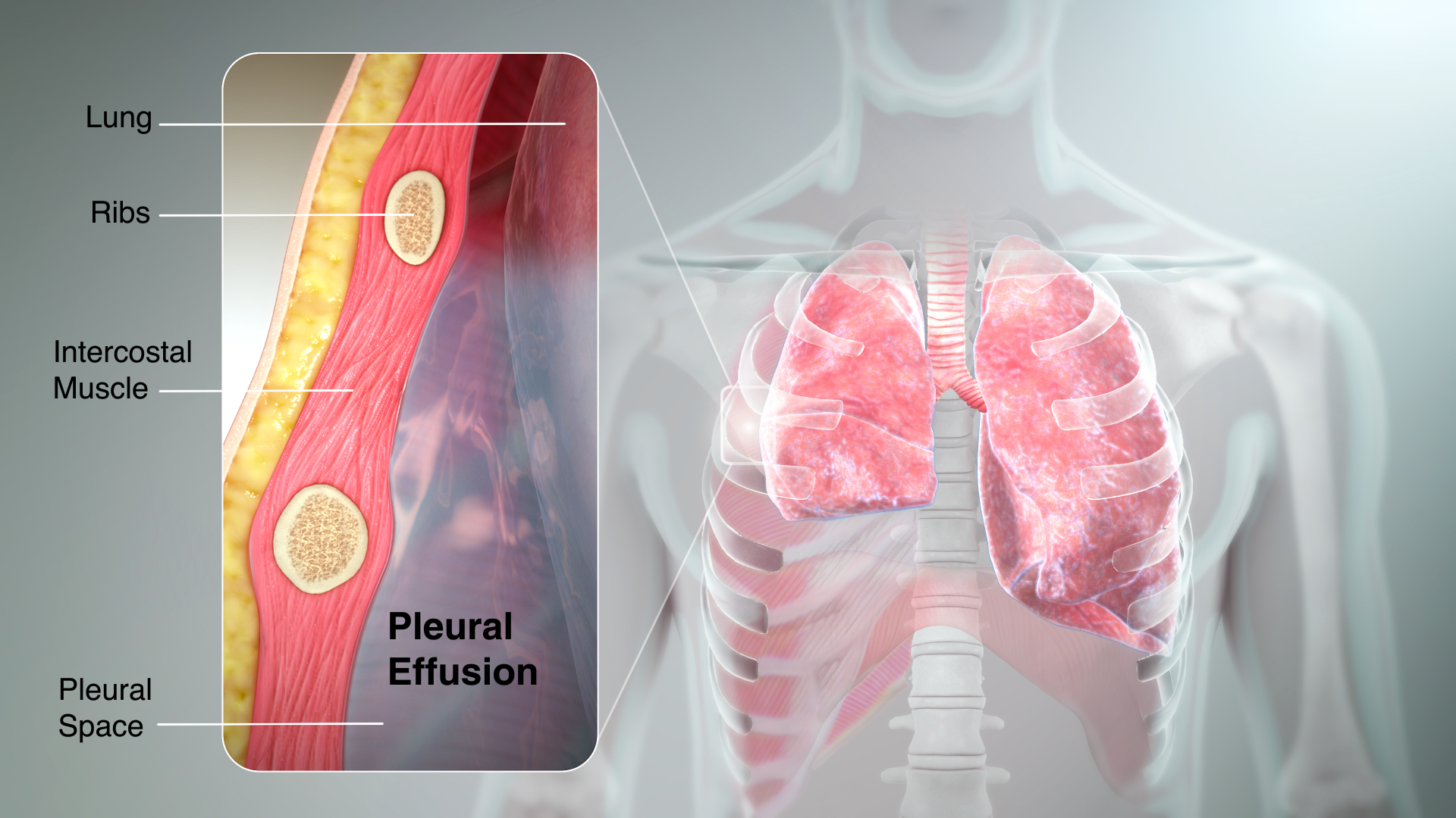 Bloody Pleural Effusion