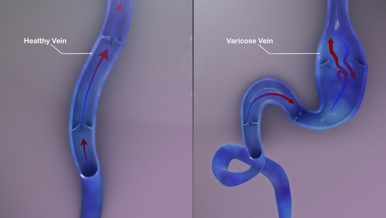 Healthy Vein vs Varicose Veins - 3D Medical Illustration - Scientific  Animations