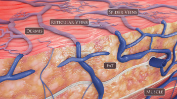 3d Medical Illustration - Skin Cross-section - IOW46