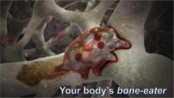 Osteoclast - The Bone-Eater in 3D