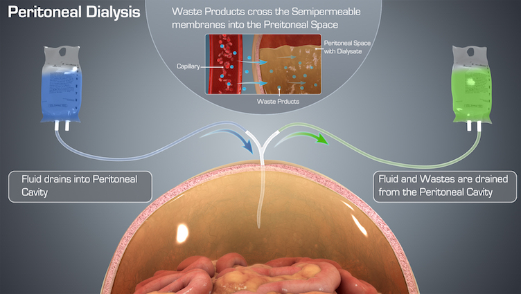 Peritoneal Dialysis