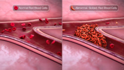 Sickle Cell Disease: Origin, Manifestation and Management