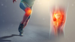 The What, Why And When Of Patellofemoral Pain Syndrome (Runner’s Knee)