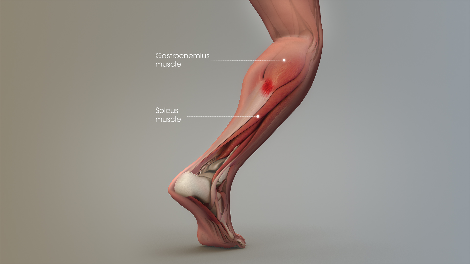 Tennis Leg and Achilles Tendonitis 