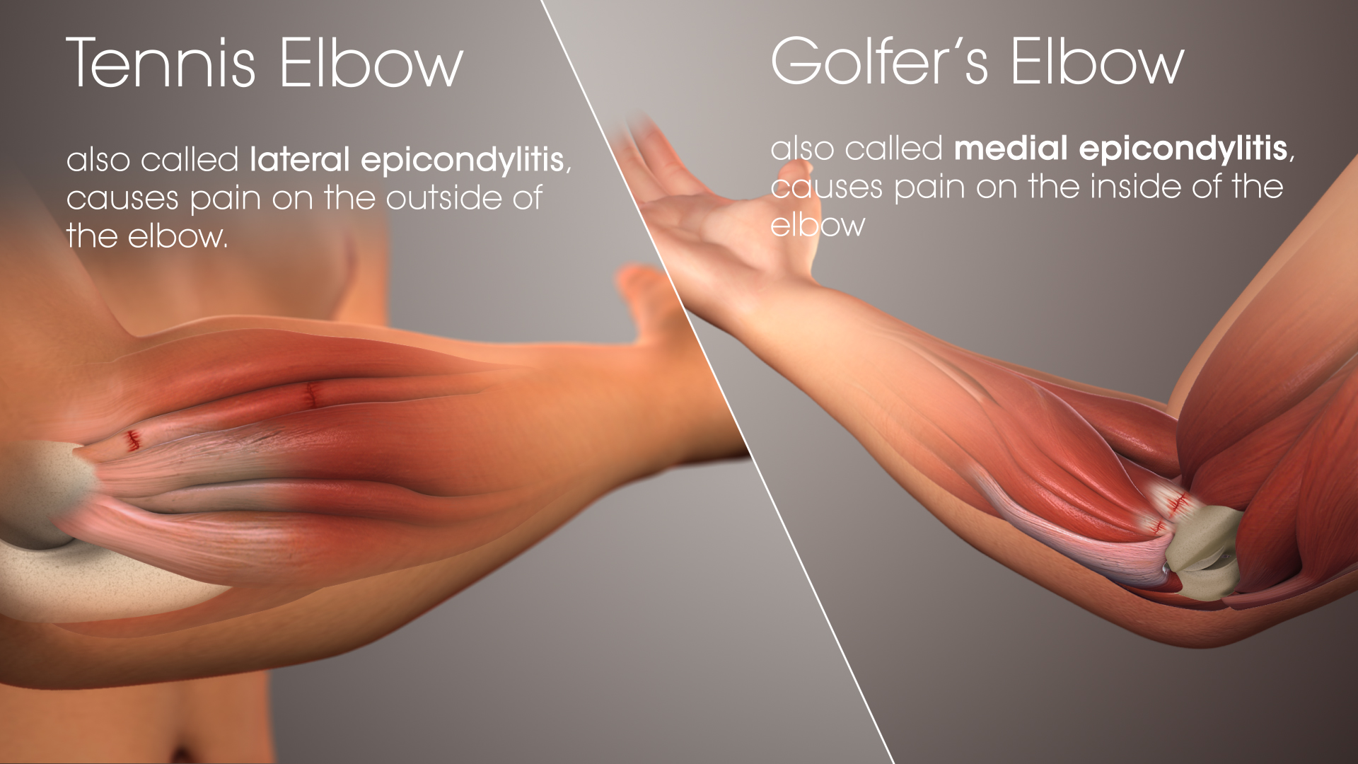 Tennis Elbow & Golfer's Elbow: A Primer - Scientific Animations