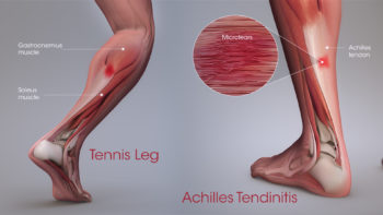 Achilles Tendinitis vs TennisLeg