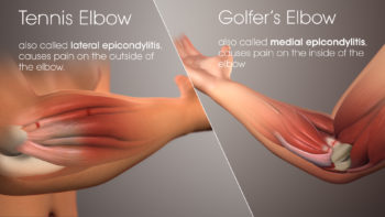 Tennis Elbow Vs Golfers Elbow SAG