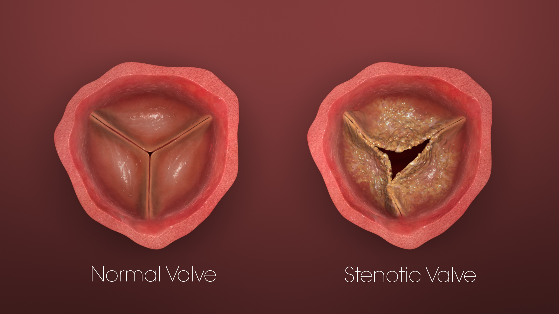 Transcatheter Heart Valves How They Revolutionized Heart Surgeries