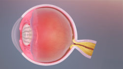 Ophthalmology Optical Nerve