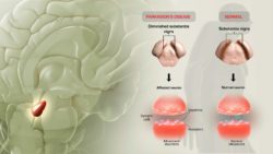 Parkinson’s disease: What goes wrong?