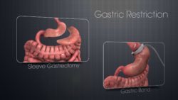 Gastric restriction To Get Rid Of Obesity