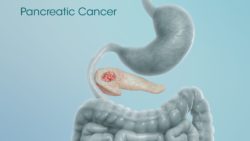 A medical animation still showing Pancreatic Cancer