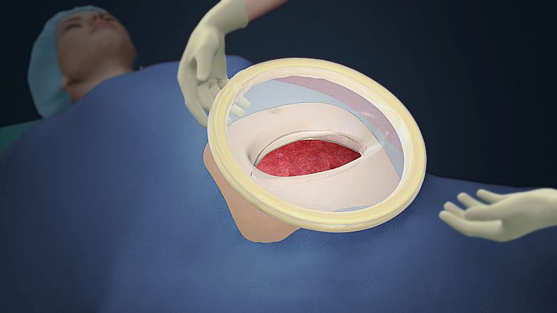 medical-animation-showing-cesarean-section-surgery - Scientific Animations