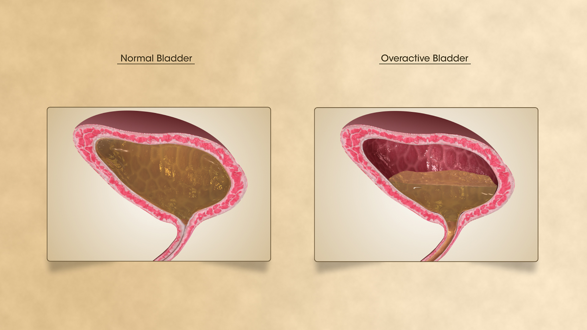 does flomax help overactive bladder