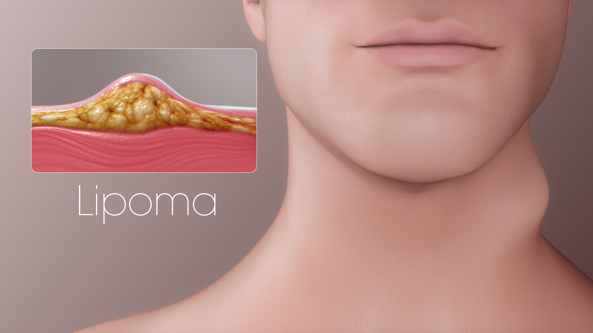 A 3D Medical illustration of Lipoma