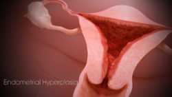 How To Survive With Endometriosis