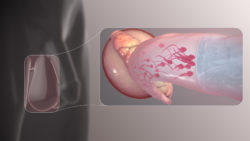 Vasalgel: A male contraceptive to look forward to…