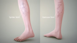 The Science behind Spider Veins